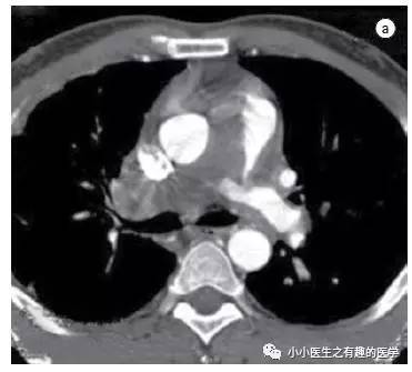 肺动脉充盈缺损不一定是血栓—学习被老外误诊误治的肺栓塞