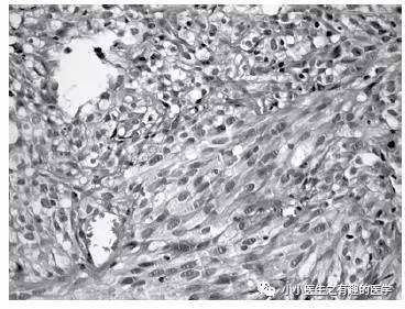 肺动脉充盈缺损不一定是血栓—学习被老外误诊误治的肺栓塞