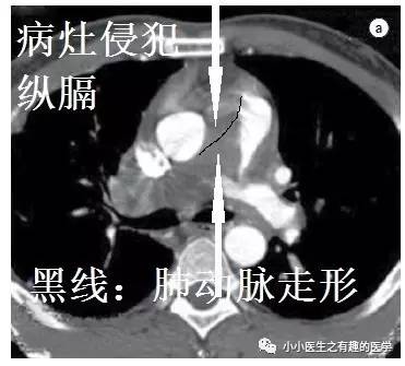 肺动脉充盈缺损不一定是血栓—学习被老外误诊误治的肺栓塞