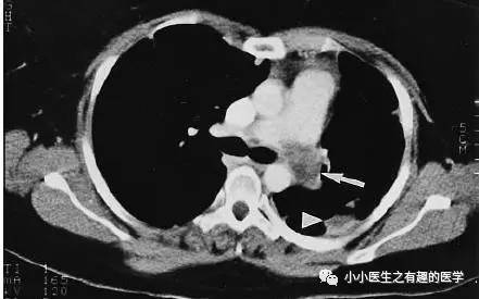 肺动脉充盈缺损不一定是血栓—学习被老外误诊误治的肺栓塞