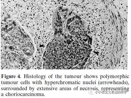 肺动脉充盈缺损不一定是血栓—学习被老外误诊误治的肺栓塞