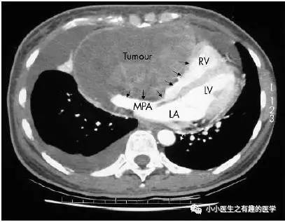 肺动脉充盈缺损不一定是血栓—学习被老外误诊误治的肺栓塞