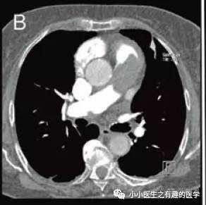 肺动脉充盈缺损不一定是血栓—学习被老外误诊误治的肺栓塞
