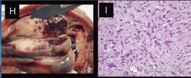 肺动脉充盈缺损不一定是血栓—学习被老外误诊误治的肺栓塞