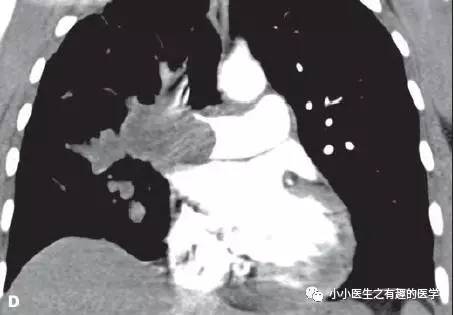 肺动脉充盈缺损不一定是血栓—学习被老外误诊误治的肺栓塞