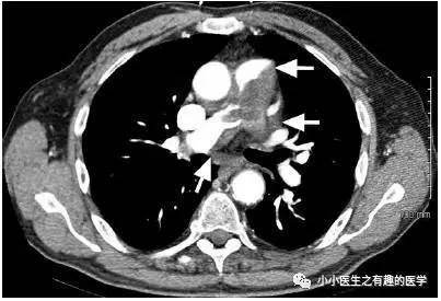 肺动脉充盈缺损不一定是血栓—学习被老外误诊误治的肺栓塞