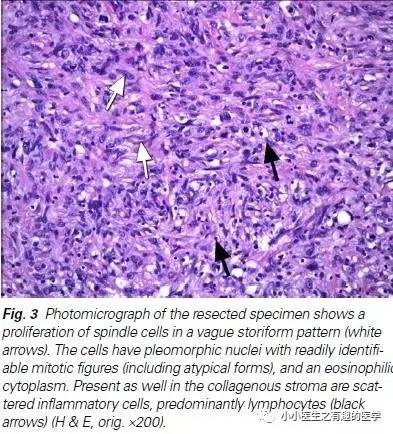 肺动脉充盈缺损不一定是血栓—学习被老外误诊误治的肺栓塞