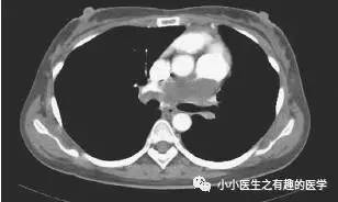 肺动脉充盈缺损不一定是血栓—学习被老外误诊误治的肺栓塞