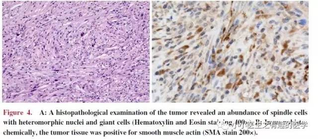 肺动脉充盈缺损不一定是血栓—学习被老外误诊误治的肺栓塞