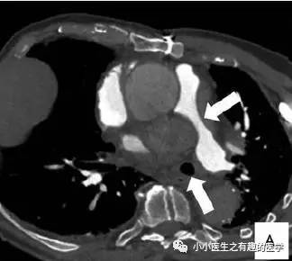肺动脉充盈缺损不一定是血栓—学习被老外误诊误治的肺栓塞