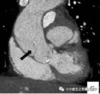 肺动脉充盈缺损不一定是血栓—学习被老外误诊误治的肺栓塞
