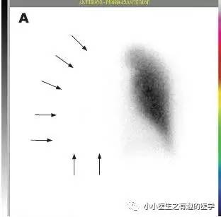 肺动脉充盈缺损不一定是血栓—学习被老外误诊误治的肺栓塞