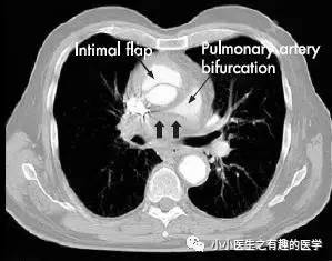 肺动脉充盈缺损不一定是血栓—学习被老外误诊误治的肺栓塞