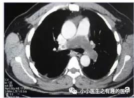 肺动脉充盈缺损不一定是血栓—学习被老外误诊误治的肺栓塞