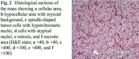 肺动脉充盈缺损不一定是血栓—学习被老外误诊误治的肺栓塞
