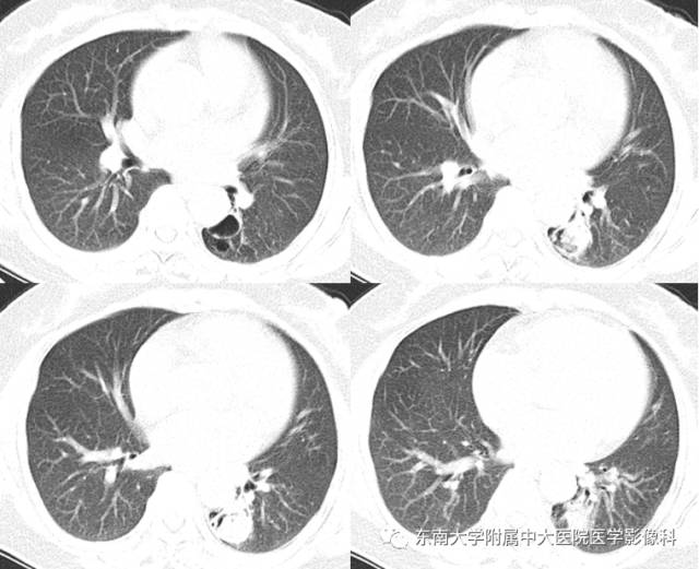 【病例】左下肺支气管囊肿伴肺曲霉菌感染