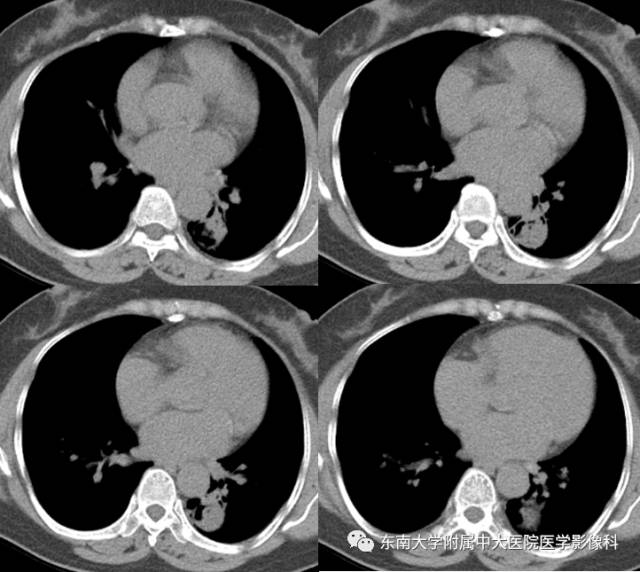 【病例】左下肺支气管囊肿伴肺曲霉菌感染