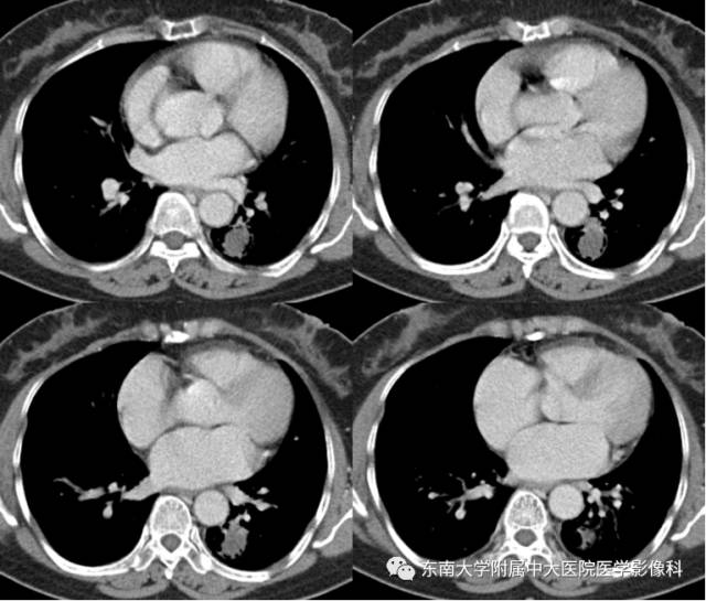 【病例】左下肺支气管囊肿伴肺曲霉菌感染