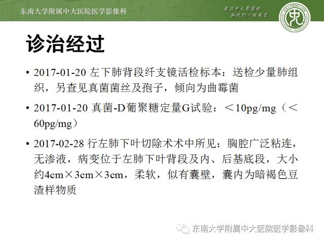 【病例】左下肺支气管囊肿伴肺曲霉菌感染