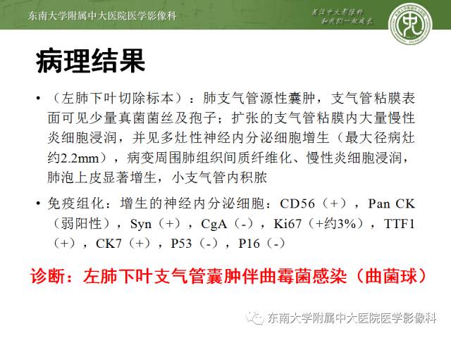 【病例】左下肺支气管囊肿伴肺曲霉菌感染