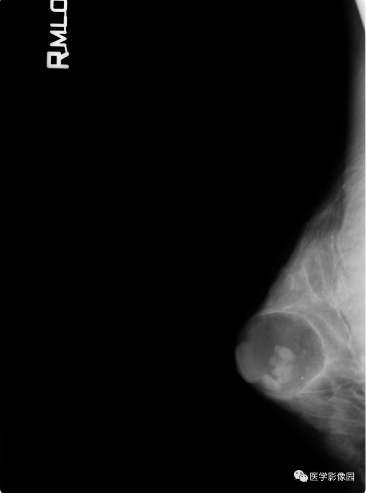 【病例】乳腺错构瘤1例X线钼靶 【病例】乳腺错构瘤1例X线钼靶