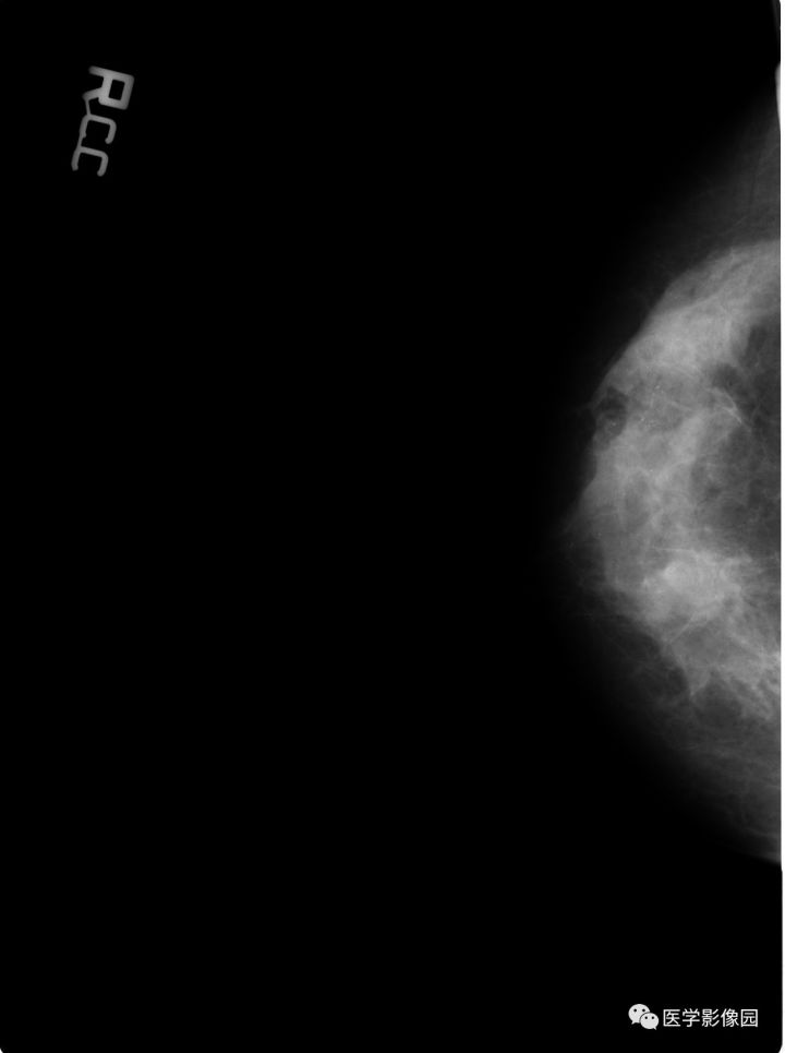 【病例】乳腺错构瘤1例X线钼靶 【病例】乳腺错构瘤1例X线钼靶