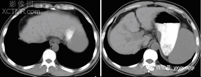 【病例】食管静脉曲张1例X线CT影像 【病例】食管静脉曲张1例X线CT影像