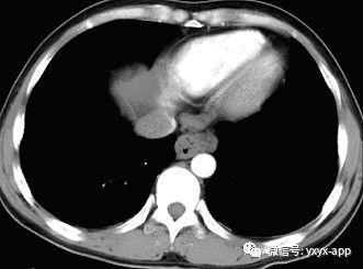 【病例】食管静脉曲张1例X线CT影像 【病例】食管静脉曲张1例X线CT影像