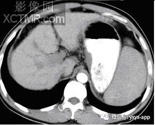 【病例】食管静脉曲张1例X线CT影像 【病例】食管静脉曲张1例X线CT影像