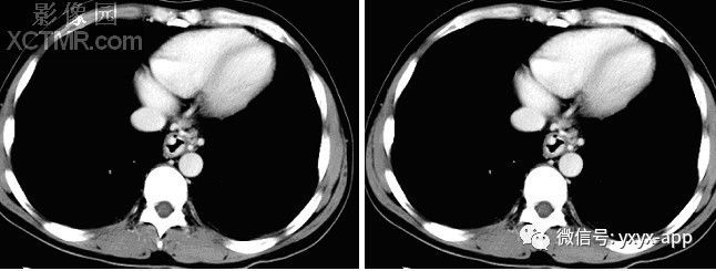 【病例】食管静脉曲张1例X线CT影像 【病例】食管静脉曲张1例X线CT影像