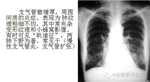 3分钟读懂胸片上肺纹理的改变 3分钟读懂胸片上肺纹理的改变