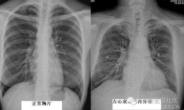 3分钟读懂胸片上肺纹理的改变 3分钟读懂胸片上肺纹理的改变