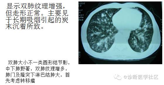 3分钟读懂胸片上肺纹理的改变 3分钟读懂胸片上肺纹理的改变