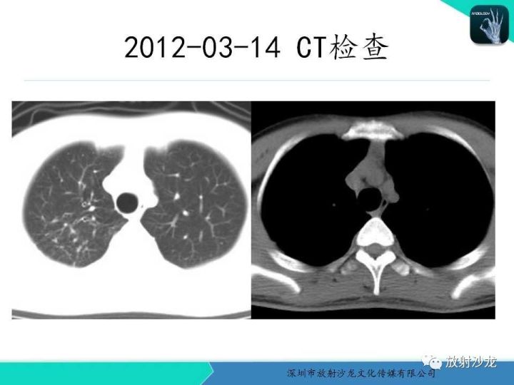 【病例】纵隔卵黄囊瘤1例CT影像表现