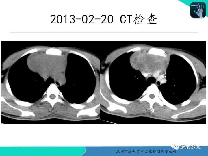 【病例】纵隔卵黄囊瘤1例CT影像表现
