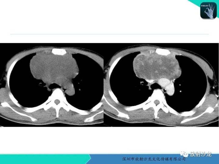 【病例】纵隔卵黄囊瘤1例CT影像表现