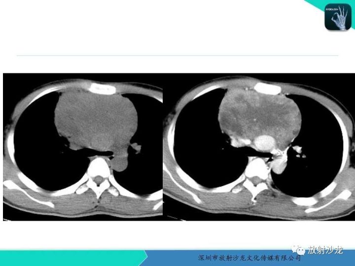【病例】纵隔卵黄囊瘤1例CT影像表现