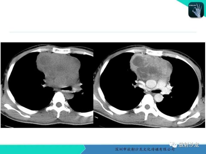 【病例】纵隔卵黄囊瘤1例CT影像表现
