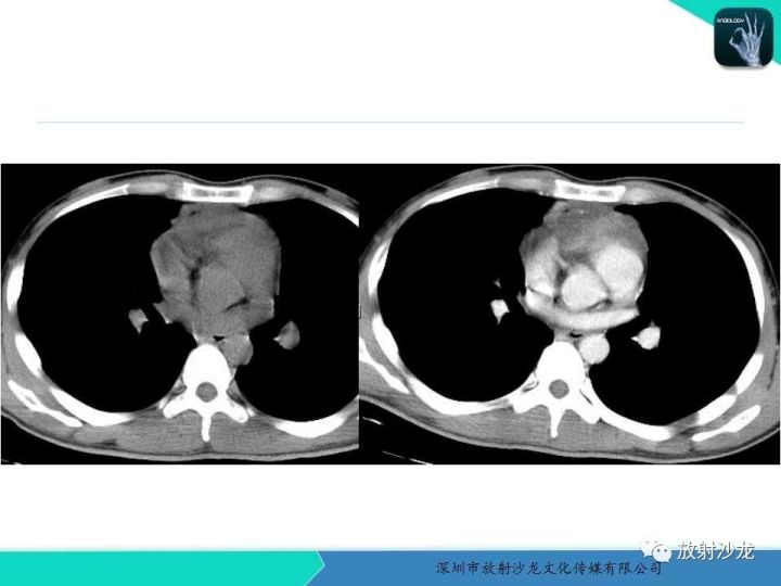 【病例】纵隔卵黄囊瘤1例CT影像表现