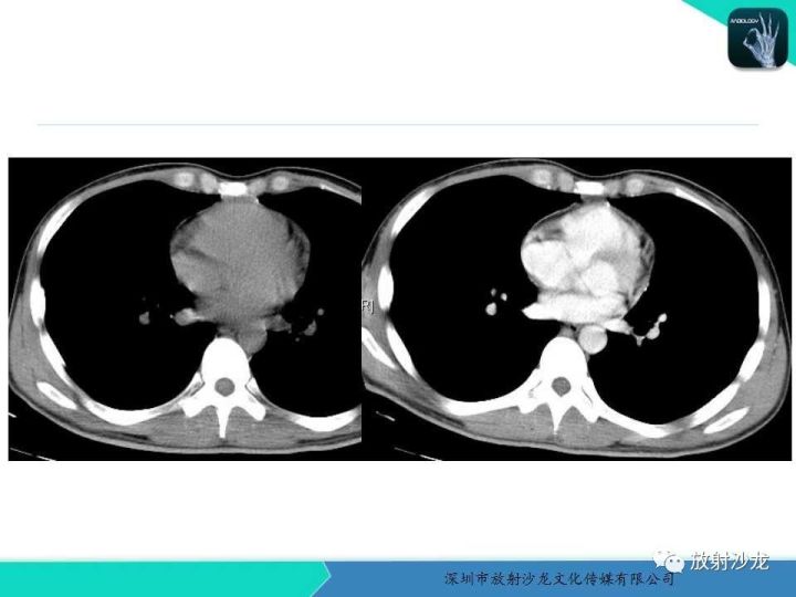 【病例】纵隔卵黄囊瘤1例CT影像表现