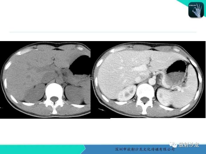 【病例】纵隔卵黄囊瘤1例CT影像表现