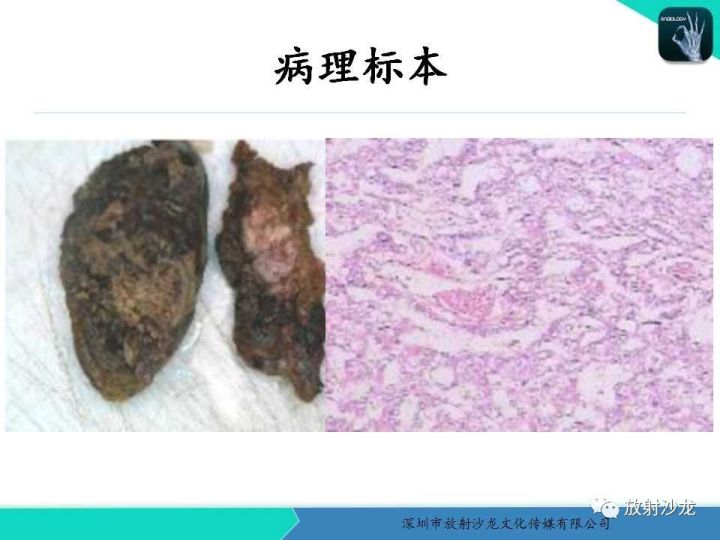 【病例】纵隔卵黄囊瘤1例CT影像表现