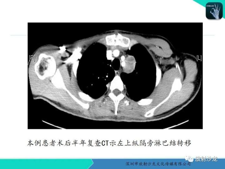 【病例】纵隔卵黄囊瘤1例CT影像表现