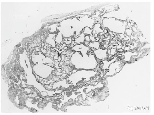 肺淋巴管肌瘤病(LAM)的诊断与鉴别诊断 肺淋巴管肌瘤病(LAM)的诊断与鉴别诊断