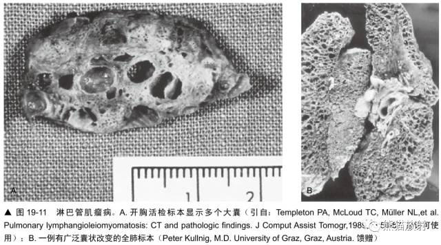 肺淋巴管肌瘤病(LAM)的诊断与鉴别诊断 肺淋巴管肌瘤病(LAM)的诊断与鉴别诊断