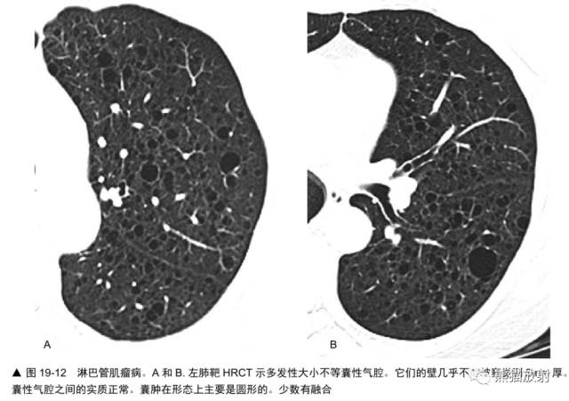 肺淋巴管肌瘤病(LAM)的诊断与鉴别诊断 肺淋巴管肌瘤病(LAM)的诊断与鉴别诊断