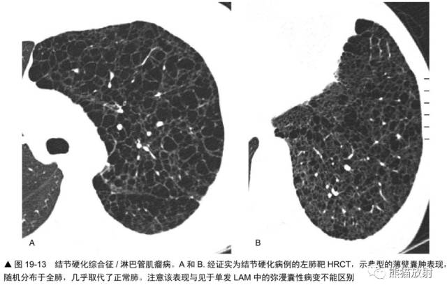 肺淋巴管肌瘤病(LAM)的诊断与鉴别诊断 肺淋巴管肌瘤病(LAM)的诊断与鉴别诊断