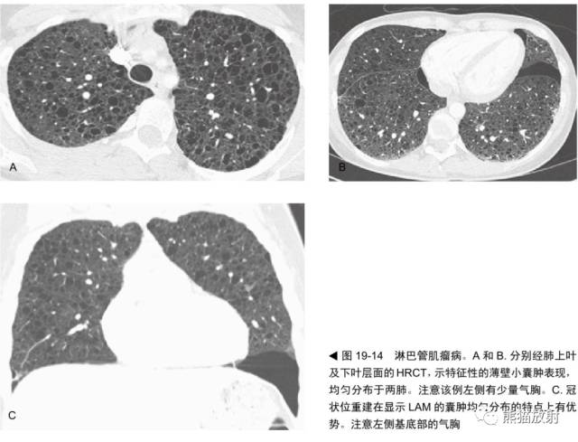 肺淋巴管肌瘤病(LAM)的诊断与鉴别诊断 肺淋巴管肌瘤病(LAM)的诊断与鉴别诊断