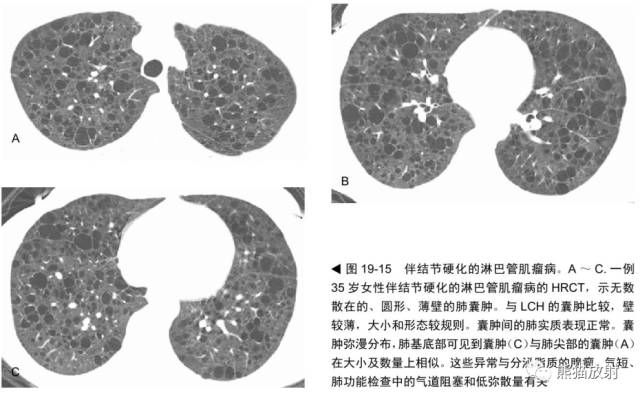 肺淋巴管肌瘤病(LAM)的诊断与鉴别诊断 肺淋巴管肌瘤病(LAM)的诊断与鉴别诊断