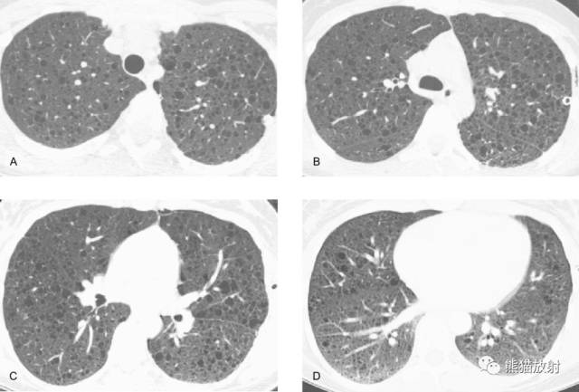 肺淋巴管肌瘤病(LAM)的诊断与鉴别诊断 肺淋巴管肌瘤病(LAM)的诊断与鉴别诊断